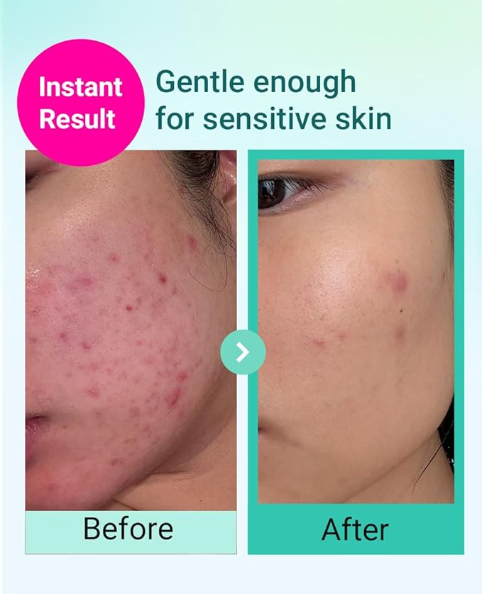 BRING GREEN TEA TREE CICA TRIAL KIT | Travel Size Korean Skin Care Set for Acne-Prone, Sensitive Skin | Zinc Teca Serum, Tea Tree Cica Moisturizer & Deep Cleansing Foam | Hydrating & Oil Control