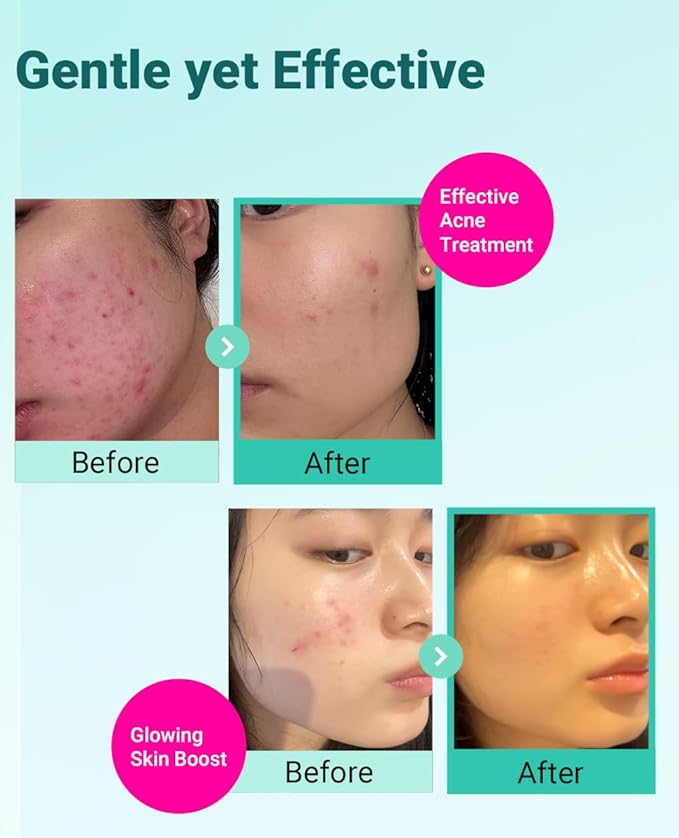 BRING GREEN TEA TREE CICA SET | Korean Skin Care Kit for Acne-Prone, Sensitive Skin | Zinc Teca Serum, Tea Tree Hydrating Moisturizer & Deep Cleansing Foam | Oil Control & Pore Care | K-Beauty Gift