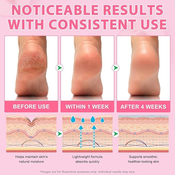 Urea Cream Foot Callus Remover Stick - 60% Urea with 2% Salicylic Acid, Professional Strength Moisturizer for Dry Cracked Feet, Heels, Knees, Elbows & Hands, Callus Removal & Skin Softening Treatment