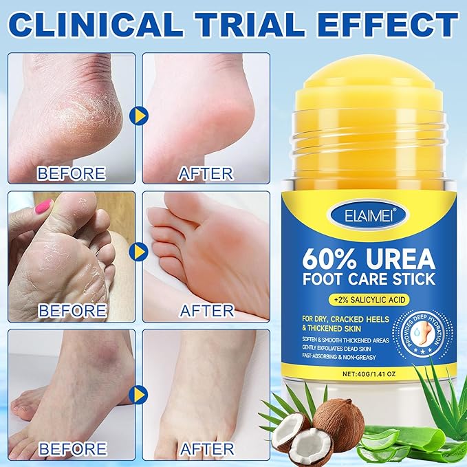 Urea Cream 60% with 2% Salicylic Acid Stick, 2Pack Urea Foot Cream for Dry Cracked Heels, Callus Remover, Hydrating and Softening Moisturizer for Feet, Hands, Knees, Elbows, Exfoliating Dead Skin
